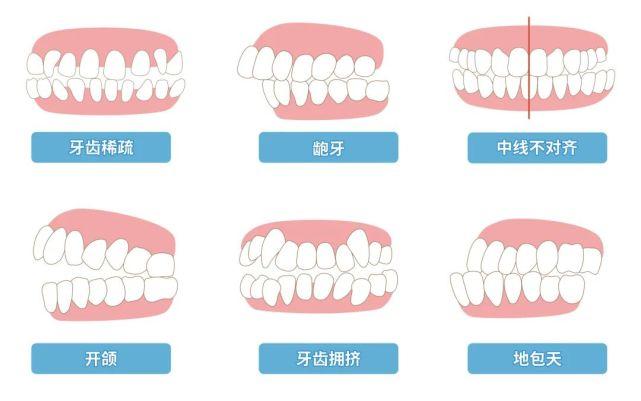 牙面畸形的分类及临床表现是什么