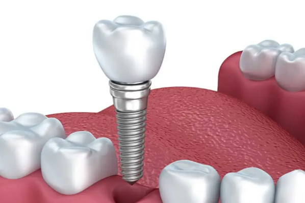 人工牙种植的术前检查