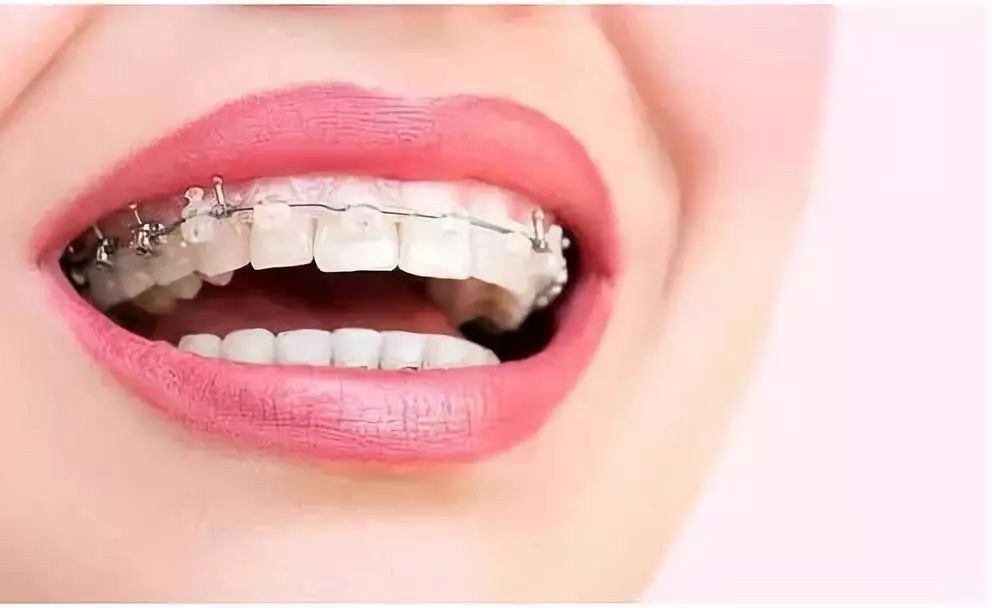 正颌手术前正畸治疗的内容是什么