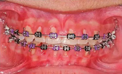 牙周病正畸矫治的特点是什么