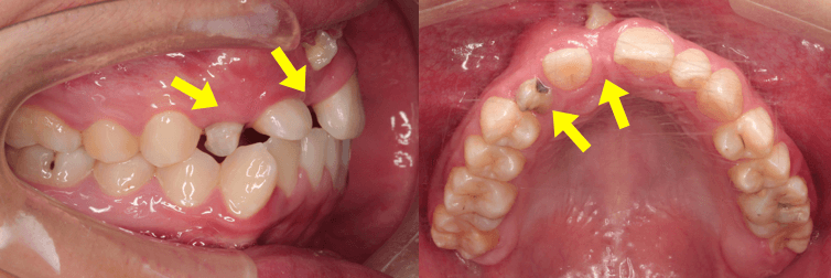 埋藏牙正畸矫治的特点