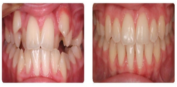 矫治埋藏牙的注意事项