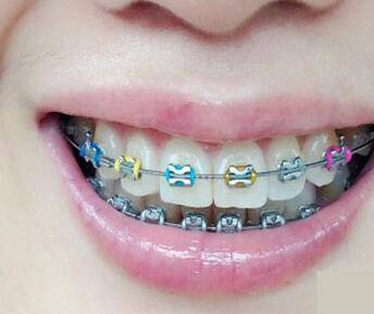 正畸与颌面外科的合作矫治