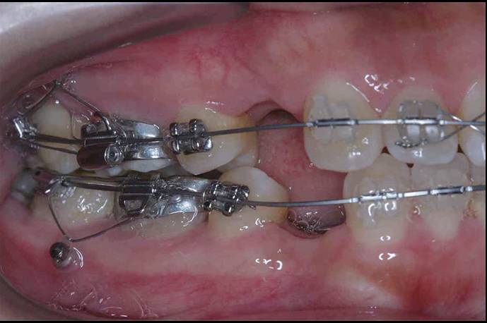 什么是Begg 细丝弓矫治技术