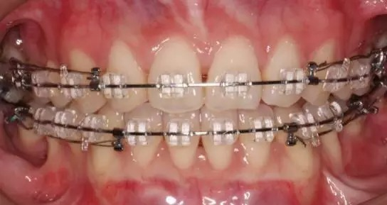正畸矫治的完成与保持