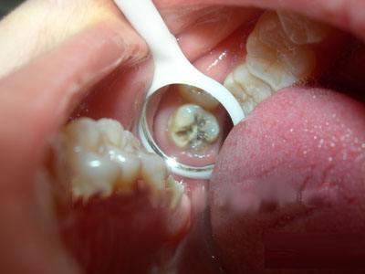 龋病发病的四联因素是什么