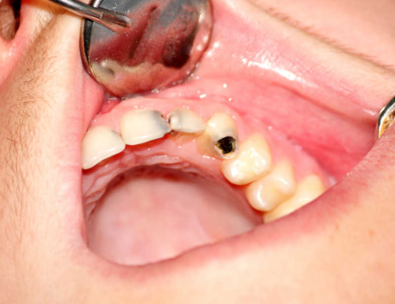 牙齿发育与龋病的关系怎样