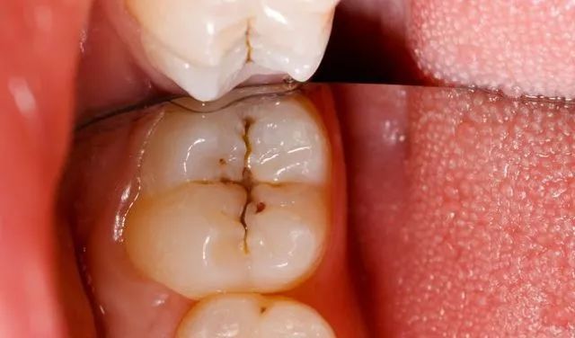 如何把龋病的发病率控制在最低限度内