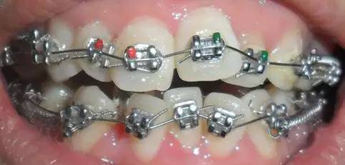 减数矫治是怎样发展的 今后的趋势如何