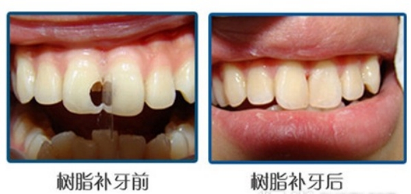 树脂修复适应证和禁忌证