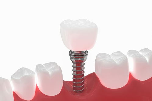 种植牙修复的操作步骤是什么