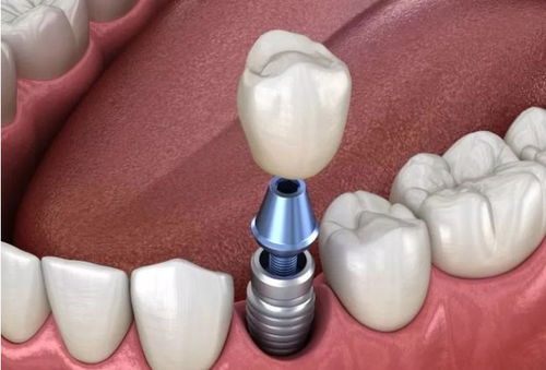 种植体的烤瓷修复