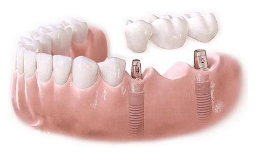 种植体的全瓷修复的优点与适应证