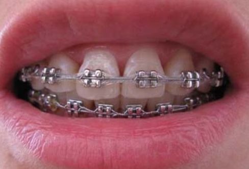 正畸中的专科检查有哪些