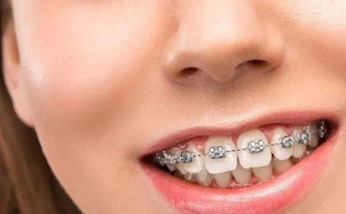 正畸后首次复诊需要做什么