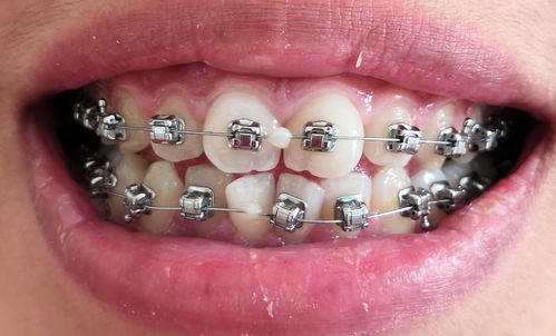 正畸中牙齿移动的机制分析与矫治器设计