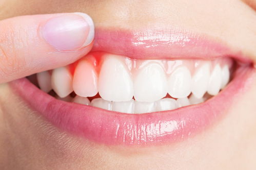 牙龈出血的原因是什么
