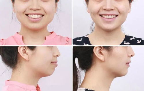 骨性错颌的病因是什么