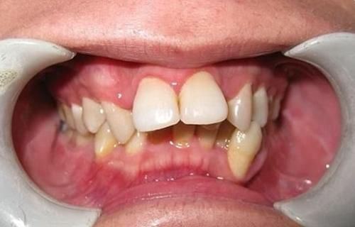 正畸中牙移动后牙周围组织的改建与恢复