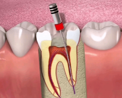 根管治疗的原则有哪些