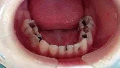 根管治疗成功的标准及其评价