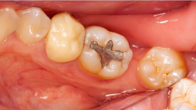 怎么样才能预防龋齿