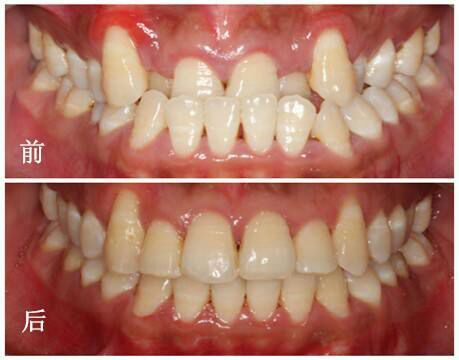 牙列拥挤是怎么得的