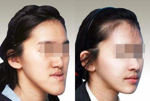 前牙反颌是怎么得的