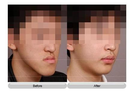 前牙反颌的临床表现是什么