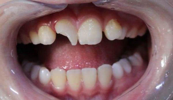 牙体缺损的病因是什么