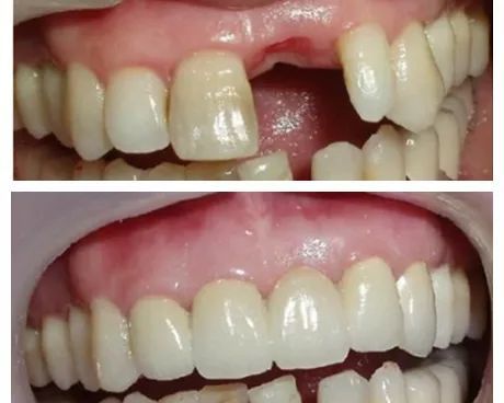牙体缺损常用的几种修复体有哪些
