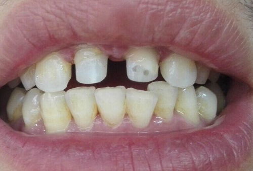 牙列缺损与不镶牙的危害是什么