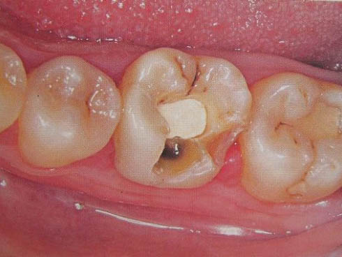 牙列缺损修复前的准备