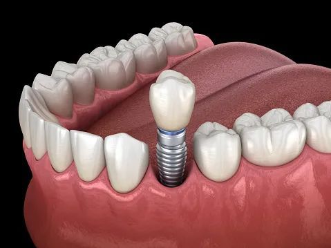 人工种植牙的手术方法是怎么样的