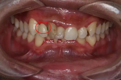 牙列拥挤的病因是什么