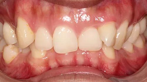 前牙深覆盖的病因是什么