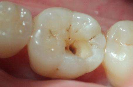 治疗龋齿有什么重要性