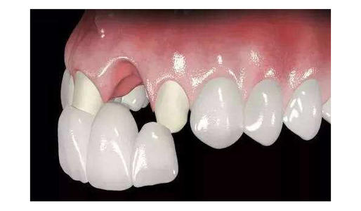 镶牙该注意些什么 