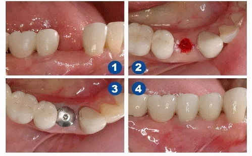 牙体缺损修复前的准备有什么