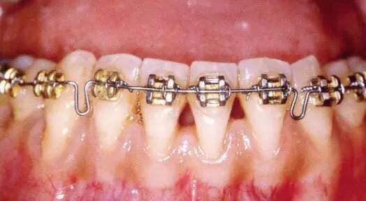 牙周病正畸治疗的有利作用是什么