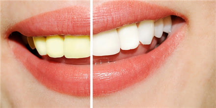 牙齿激光漂白是什么