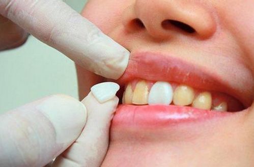 牙齿贴面的适应证是什么