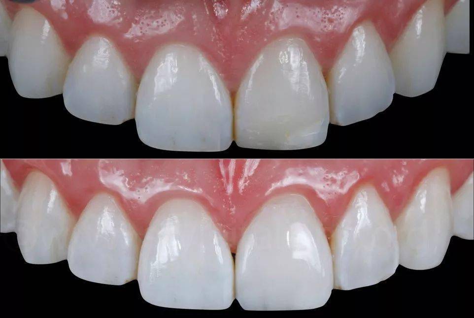 树脂修复是什么 树脂修复的步骤是什么