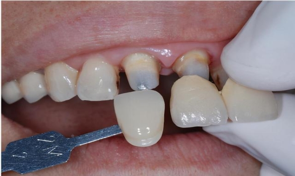 前牙稀疏的修复是什么样的