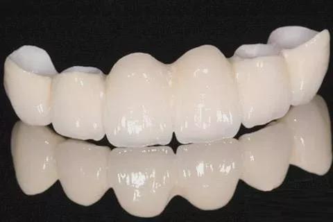 全瓷牙冠是什么