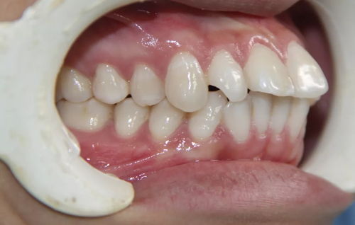 牙齿拥挤的矫治是什么样的