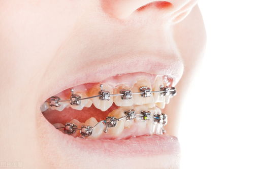 牙齿正畸后如何防止复发