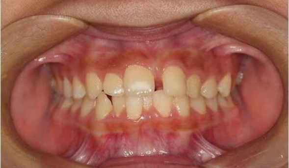 牙列不齐的矫治是什么样的