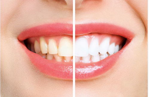 如何治疗着色的牙齿