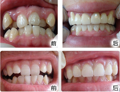 牙齿排列不齐的最佳矫治时机